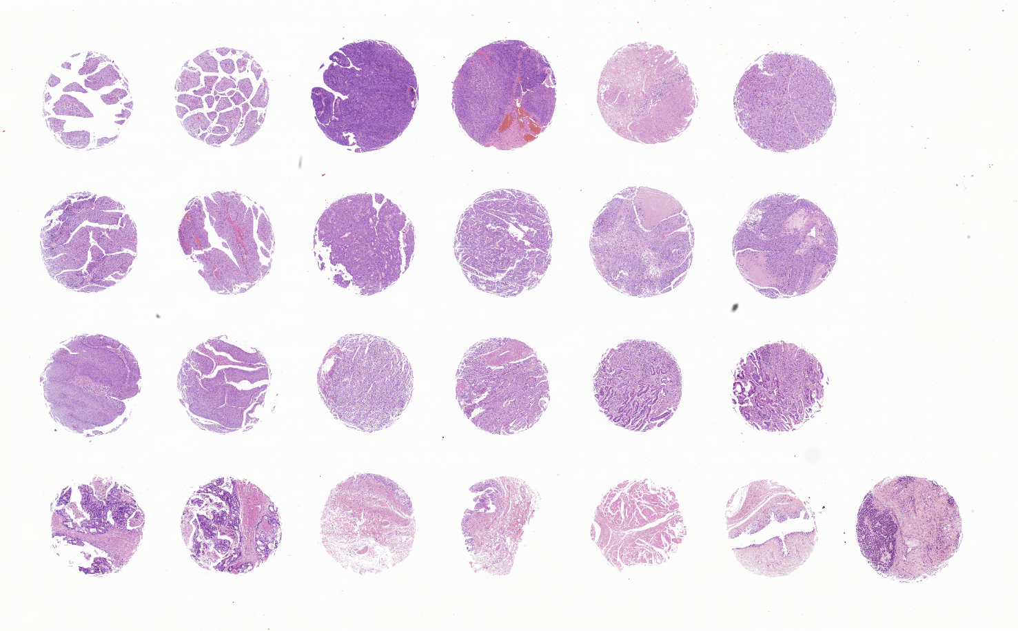 tissue microarray-UBD243a